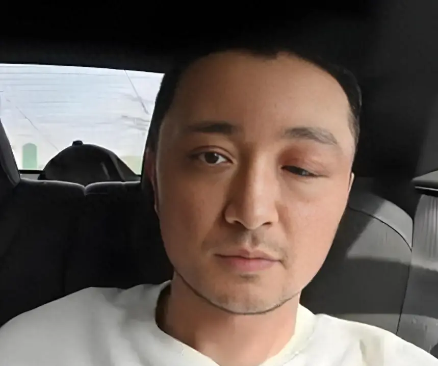 尼格买提因一只眼睛红肿冲上热搜，粗心染发致过敏的原因曝光